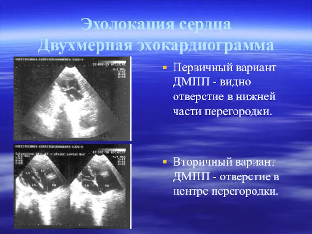 Эхолокация сердца Двухмерная эхокардиограмма Первичный вариант ДМПП - видно отверстие