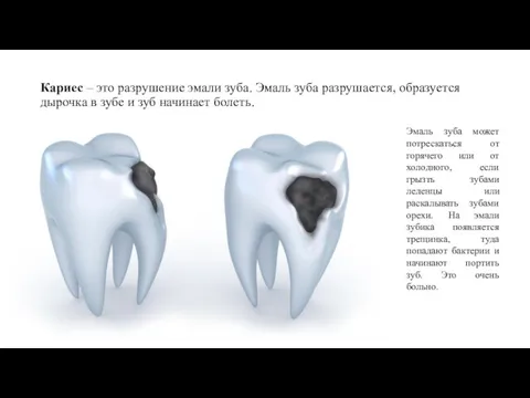 Кариес – это разрушение эмали зуба. Эмаль зуба разрушается, образуется