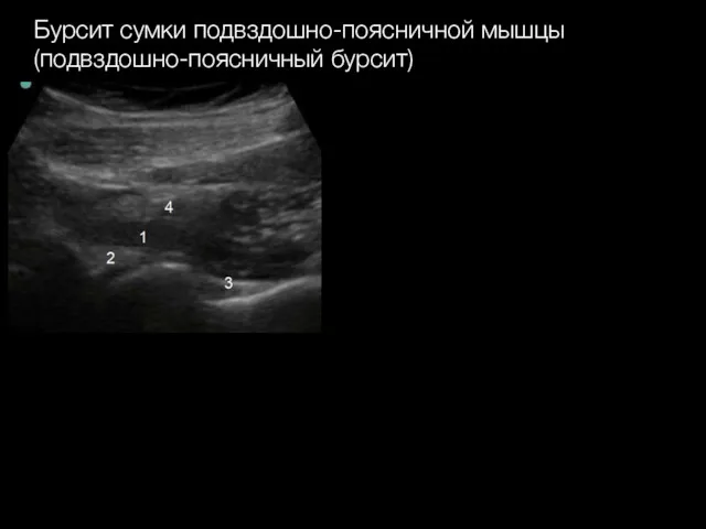 Бурсит сумки подвздошно-поясничной мышцы (подвздошно-поясничный бурсит)