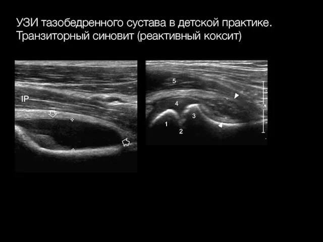 УЗИ тазобедренного сустава в детской практике. Транзиторный синовит (реактивный коксит)