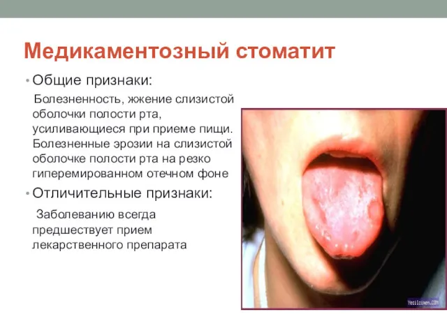 Медикаментозный стоматит Общие признаки: Болезненность, жжение слизистой оболочки полости рта,