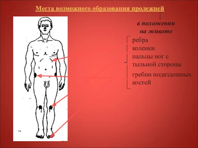 Места возможного образования пролежней в положении на животе ребра коленки пальцы ног с