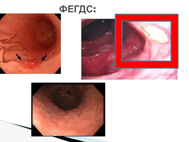 ФЕГДС: