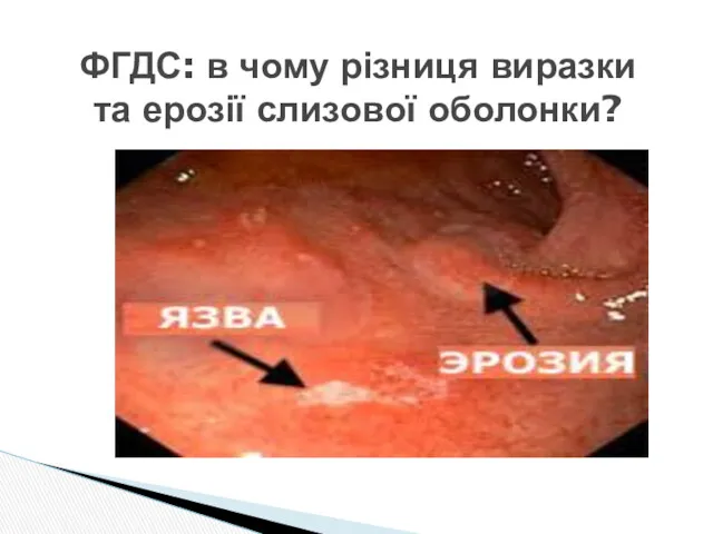 ФГДС: в чому різниця виразки та ерозії слизової оболонки?