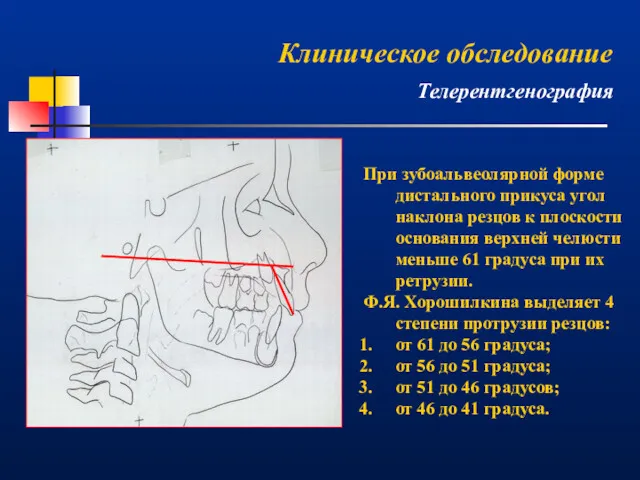 При зубоальвеолярной форме дистального прикуса угол наклона резцов к плоскости