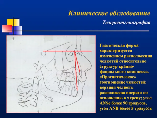 Гнатическая форма характеризуется изменением расположения челюстей относительно структур кранио-фациального комплекса.