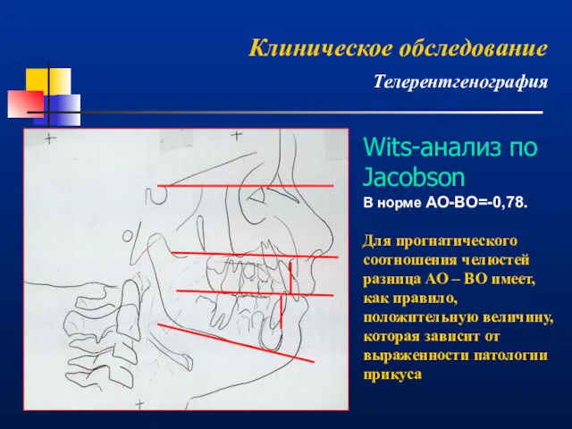 Wits-анализ по Jacobson В норме АО-ВО=-0,78. Для прогнатического соотношения челюстей