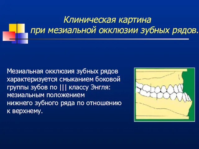 Клиническая картина при мезиальной окклюзии зубных рядов. Мезиальная окклюзия зубных