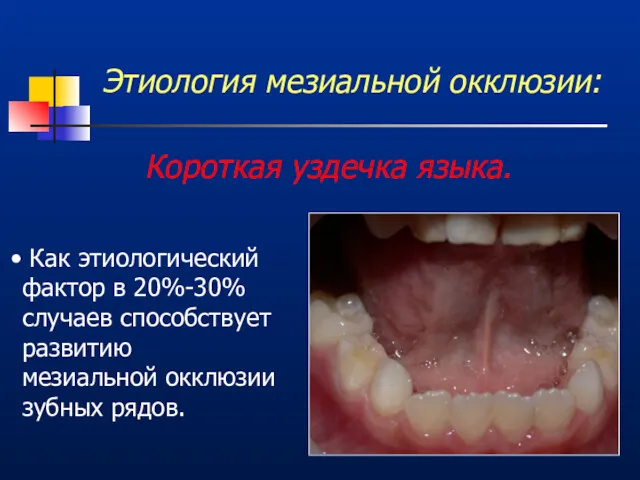 Этиология мезиальной окклюзии: Короткая уздечка языка. Как этиологический фактор в