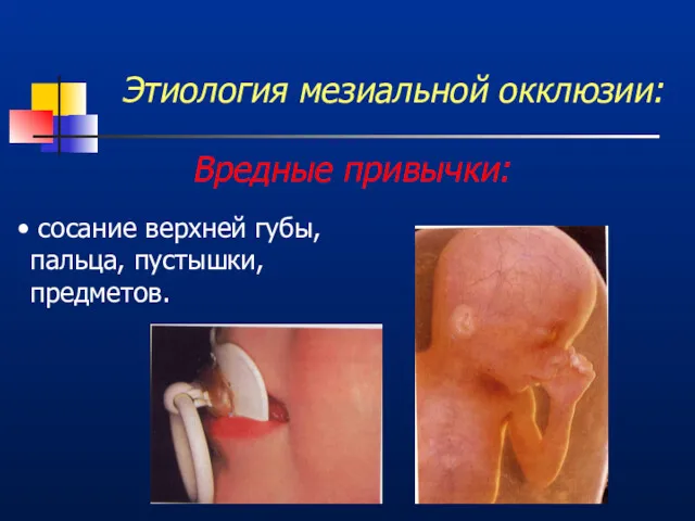 Этиология мезиальной окклюзии: Вредные привычки: сосание верхней губы, пальца, пустышки, предметов.