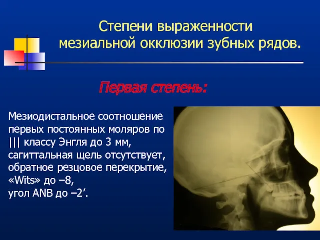 Степени выраженности мезиальной окклюзии зубных рядов. Первая степень: Мезиодистальное соотношение