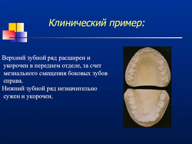 Клинический пример: Верхний зубной ряд расширен и укорочен в переднем