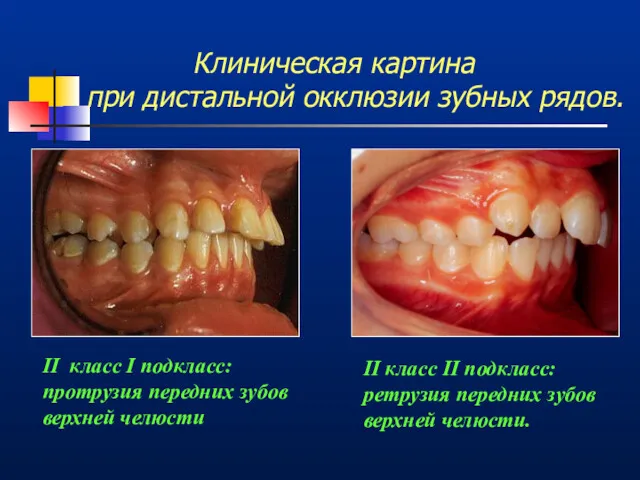 Клиническая картина при дистальной окклюзии зубных рядов. II класс I