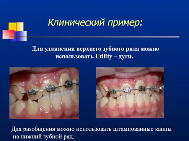 Клинический пример: Для удлинения верхнего зубного ряда можно использовать Utility