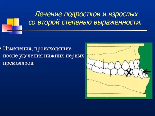 Лечение подростков и взрослых со второй степенью выраженности. Изменения, происходящие после удаления нижних первых премоляров.