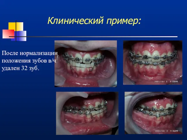 Клинический пример: После нормализации положения зубов в/ч удален 32 зуб.