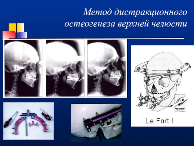 Метод дистракционного остеогенеза верхней челюсти