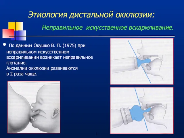 1 Этиология дистальной окклюзии: Неправильное искусственное вскармливание. По данным Окушко