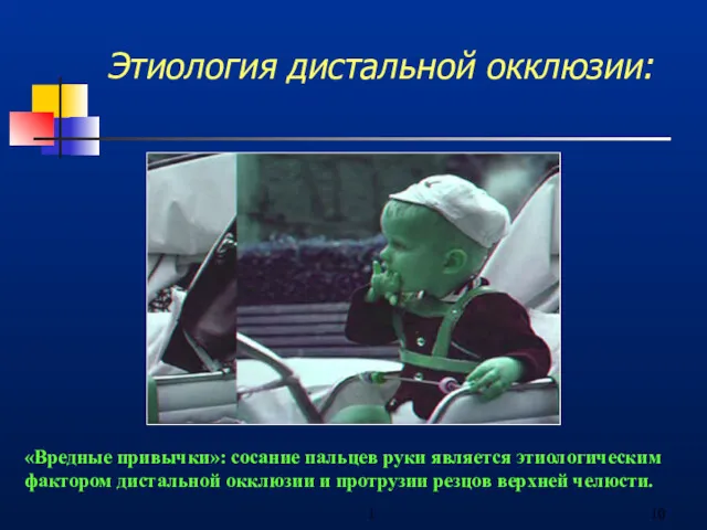 1 Этиология дистальной окклюзии: «Вредные привычки»: сосание пальцев руки является