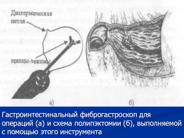 Гастроинтестинальный фиброгастроскоп для операций (а) и схема полипэктомии (б), выполняемой с помощью этого инструмента