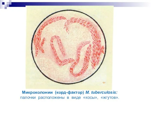 Микроколонии (корд-фактор) M. tuberculosis: палочки расположены в виде «косы», «жгутов».