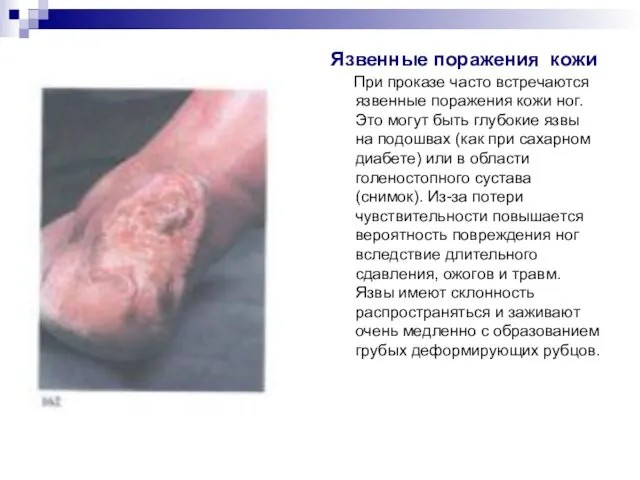 Язвенные поражения кожи При проказе часто встречаются язвенные поражения кожи