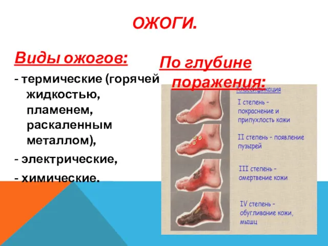 Виды ожогов: - термические (горячей жидкостью, пламенем, раскаленным металлом), -