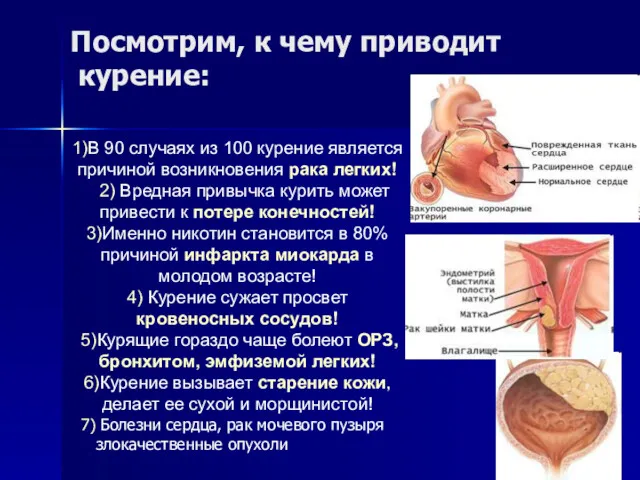 Посмотрим, к чему приводит курение: 1)В 90 случаях из 100