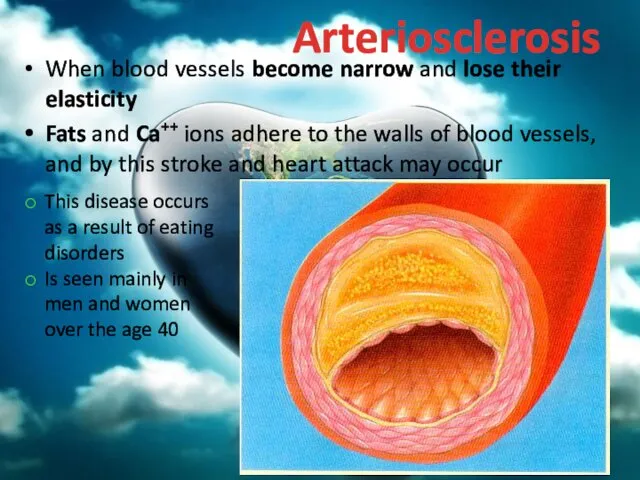 Arteriosclerosis When blood vessels become narrow and lose their elasticity