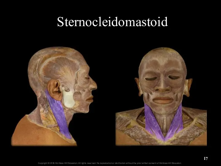 Sternocleidomastoid