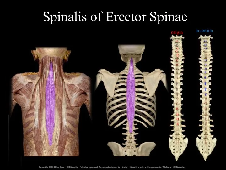 Spinalis of Erector Spinae origin insertion