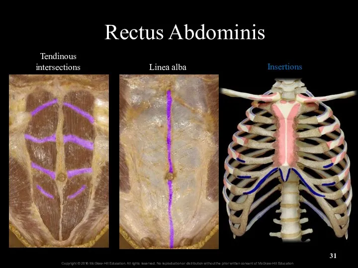 Rectus Abdominis Tendinous intersections Linea alba Insertions