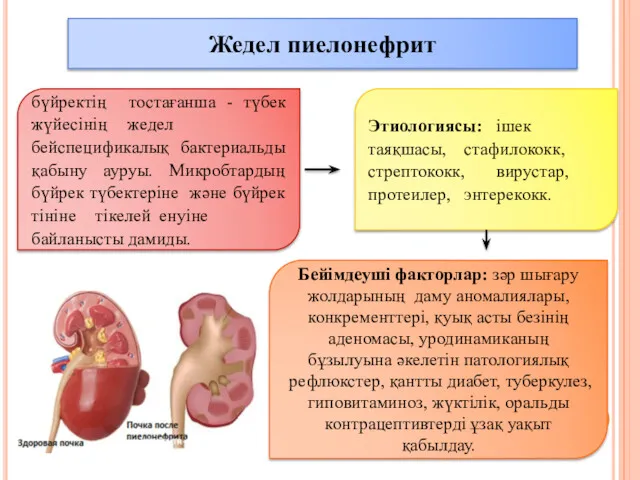 Жедел пиелонефрит бүйректің тостағанша - түбек жүйесінің жедел бейспецификалық бактериальды