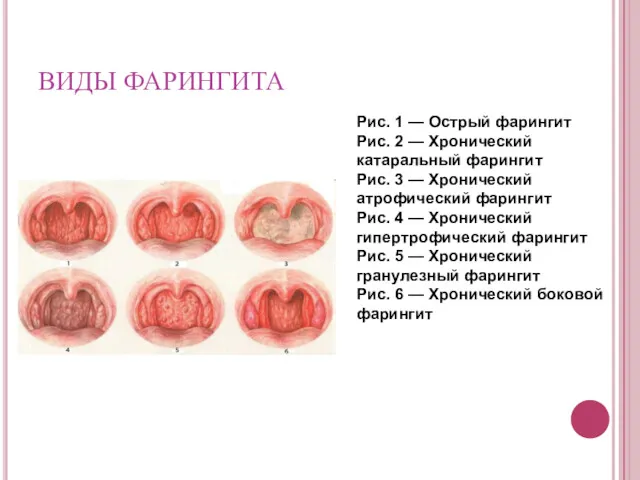 ВИДЫ ФАРИНГИТА Рис. 1 — Острый фарингит Рис. 2 —