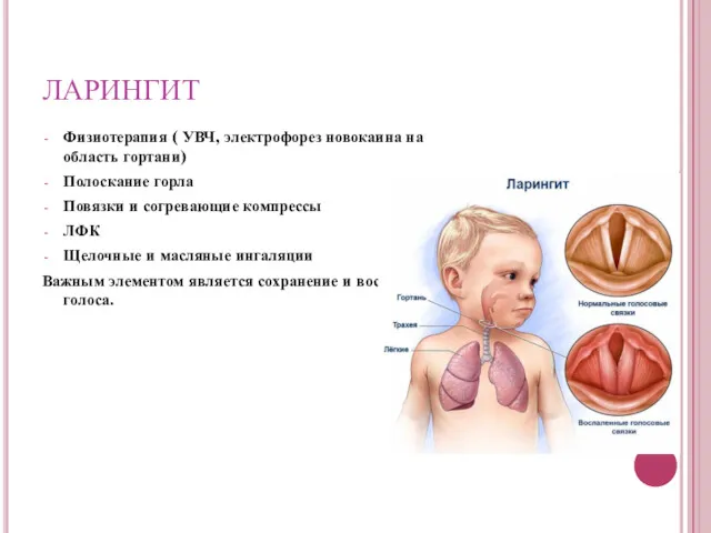 ЛАРИНГИТ Физиотерапия ( УВЧ, электрофорез новокаина на область гортани) Полоскание