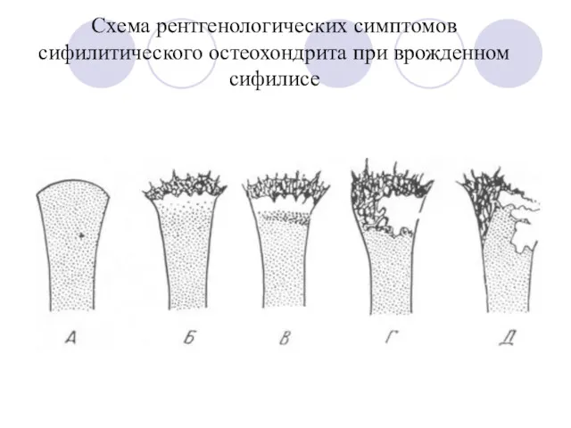 Схема рентгенологических симптомов сифилитического остеохондрита при врожденном сифилисе