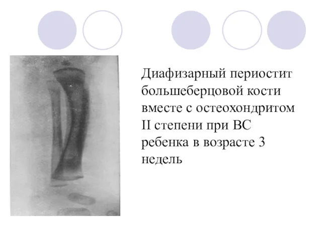 Диафизарный периостит большеберцовой кости вместе с остеохондритом II степени при ВС ребенка в возрасте 3 недель