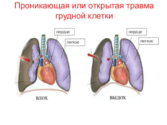 Проникающая или открытая травма грудной клетки сердце легкое легкое сердце