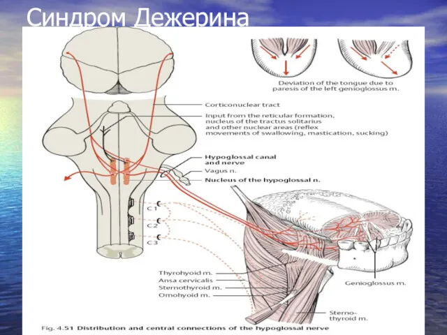 Синдром Дежерина