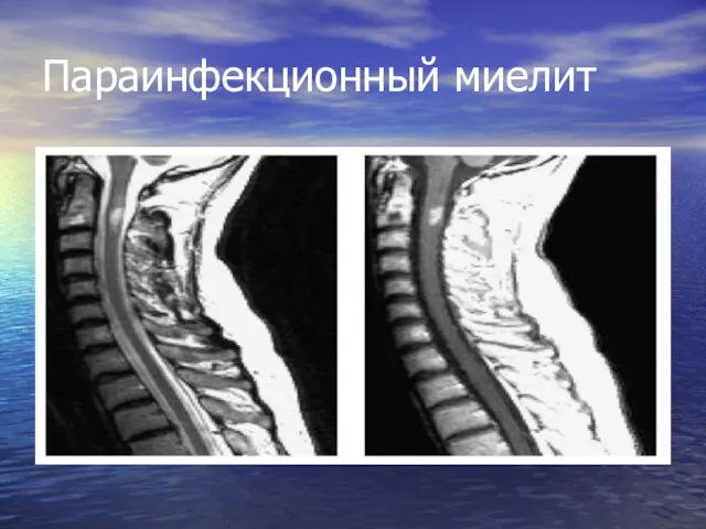 Параинфекционный миелит