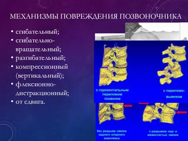 МЕХАНИЗМЫ ПОВРЕЖДЕНИЯ ПОЗВОНОЧНИКА сгибательный; сгибательно-вращательный; разгибательный; компрессионный (вертикальный); флексионно-дистракционный; от сдвига.