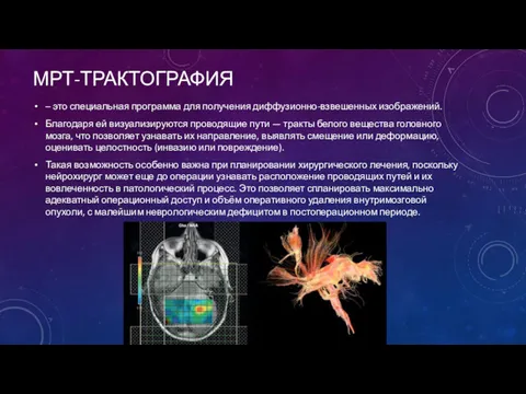 МРТ-ТРАКТОГРАФИЯ – это специальная программа для получения диффузионно-взвешенных изображений. Благодаря