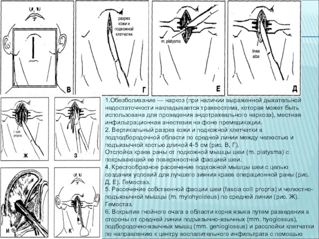 1.Обезболивание — наркоз (при наличии выраженной дыхательной недостаточности накладывается трахеостома,