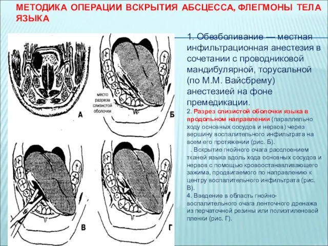 МЕТОДИКА ОПЕРАЦИИ ВСКРЫТИЯ АБСЦЕССА, ФЛЕГМОНЫ ТЕЛА ЯЗЫКА 1. Обезболивание —