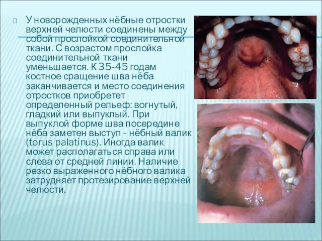 У новорожденных нёбные отростки верхней челюсти соединены между собой прослойкой