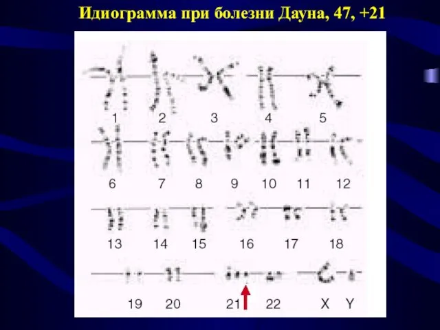 Идиограмма при болезни Дауна, 47, +21