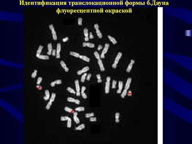 Идентификация транслокационной формы б.Дауна флуоресцентной окраской