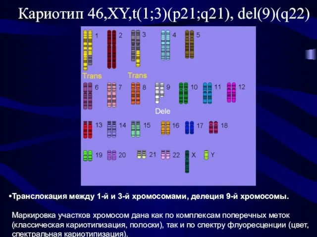 Кариотип 46,XY,t(1;3)(p21;q21), del(9)(q22) Транслокация между 1-й и 3-й хромосомами, делеция