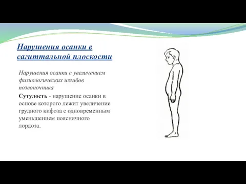 Нарушения осанки в сагиттальной плоскости Нарушения осанки с увеличением физиологических