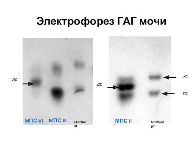 Электрофорез ГАГ мочи ХС ГС МПС II MПС III MПС VI ДС стандарт стандарт ДС